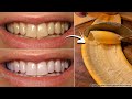 Secret that Dentists don't want you to know Remove Tartar and Teeth Whitening in just 2 minutes
