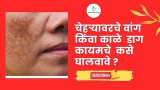 चेहर्‍यावरचे वांग / काळे डाग/ Pigmentation यावर खात्रीशीर उपाय