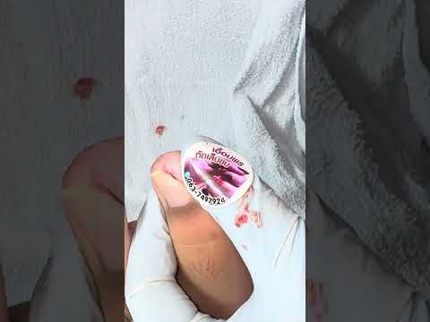 Ep_7839 *Ingrown toenail removal 👣 หนูดูนะ..มันหายไปแล้ว 😄 (clip from Thailand)