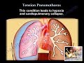 Tension Pneumothorax Treatment and Symptoms