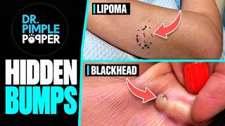 Dr. Pimple Popper vs. Two Hidden Bumps