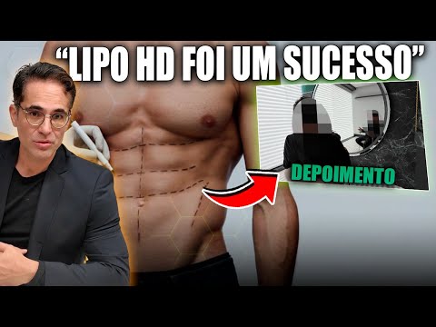 DEPOIMENTO: PACIENTE DE LIPO HD MASCULINO | CIRURGIA PLÁSTICA