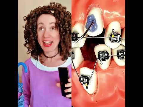 #braces #funny #foryou #bracesoff #strongteethforbetteryou #braceslife