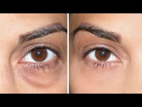 How to get rid of dark circles and puffy eyes 