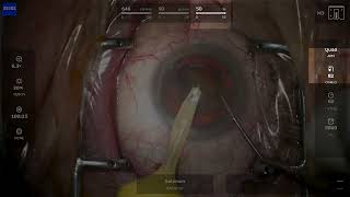 ZEISS QUATERA 700 Cataract Removal Case Chop Technique - Dr. Solomon
