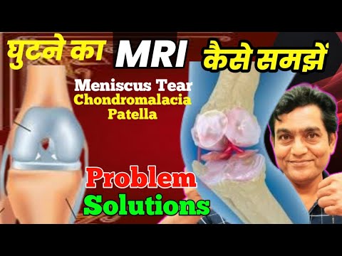 Knee MRI कैसे समझें | Meniscus Tear | Chondromalacia Patella | synovial fluid | Knee Cartilage