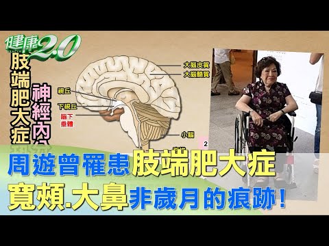 寬頰.大鼻非歲月的痕跡！ 周遊曾罹患肢端肥大症 健康2.0