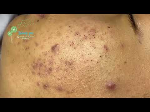 Blackheads & Acne Treatment Latest Update Dec-11-24