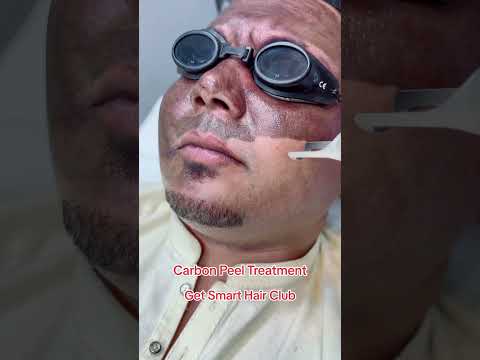 Carbon Laser ๏ฟผFacial #getsmarthairclub #skintreatment #shorts #shortvideo #shortsfeed