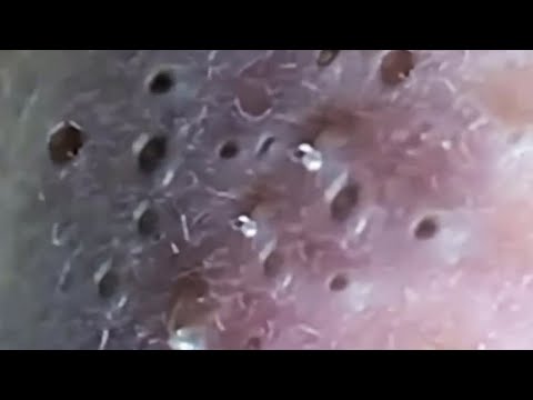 Blackheads & Whiteheads Satisfying Removal @0536