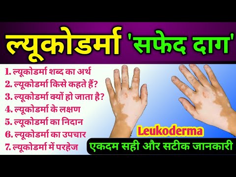 ल्यूकोडर्मा (Leukoderma) रोग | ल्यूकोडर्मा के लक्षण, कारण, उपचार | All About Leukoderma disease