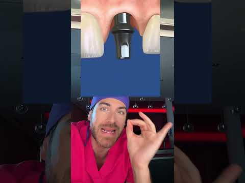 Voici 3 solutions pour remplacer une dent manquante: #shorts