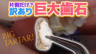 【歯石除去】片側だけ？訳あり巨大歯石‼️