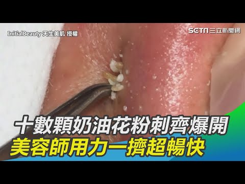 十數顆奶油花粉刺齊爆開　美容師用力一擠超暢快｜三立新聞網SETN.com
