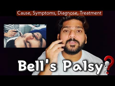 BELL'S PALSY: Symptoms, Treatment & Best Exercise | Facial Paralysis पूरी जानकारी के साथ मेरी कहानी