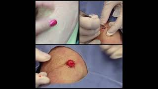 Lipoma Forearm Pop