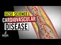 Coronary Heart Disease and Treatments