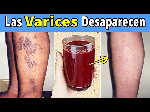Decir Adiós A Las Varices Y A La Mala Circulación Con Este Remedio Natural