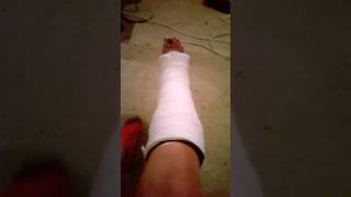 Ankle sprain cast