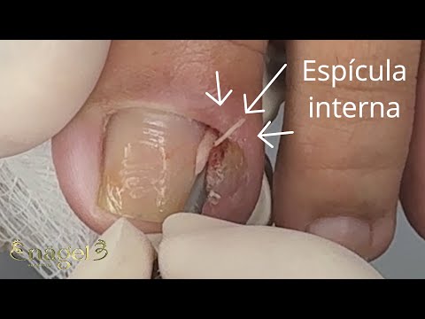 Unha Encravada Resistente: Tive que Fazer DUAS Vezes para resolver #satisfying #nails