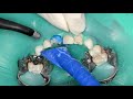 3M Strip Crown Procedure Essentials