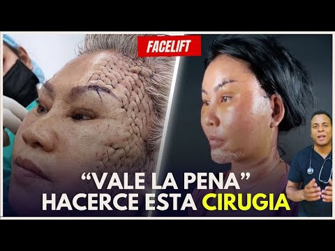 ¿Qué es el Rejuvenecimiento Facial? FACELIFT/ ¿Cómo se realiza el Rejuvenecimiento Facial