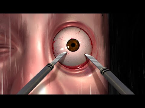 Bob & Wade React To Mark's Eye Surgery