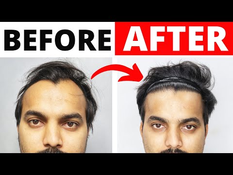 Derma Technique Exposed 🔥 Is Derma the Future Of Hair Transplant Result ? Hair Transplant Cost India
