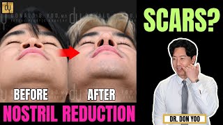 No Scar Nostril Reduction | Alarplasty -  Beverly Hills Plastic Surgeon Explains #nosejob