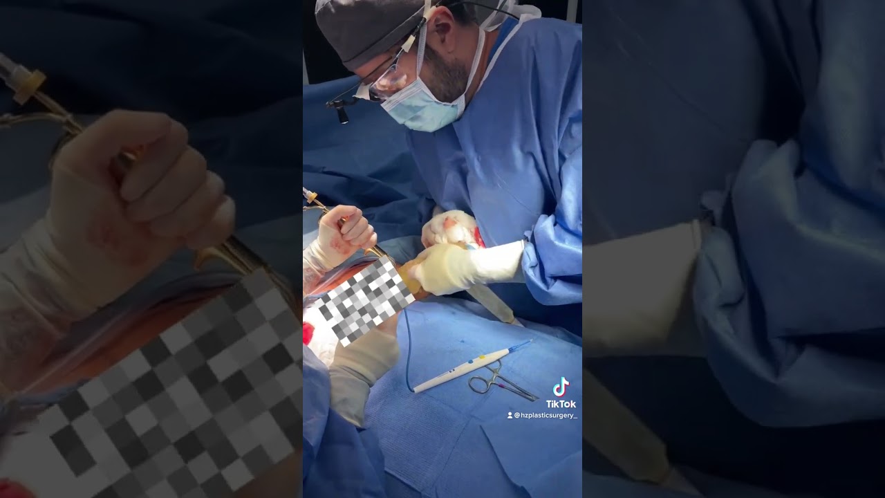 Surgical procedure being performed by medical professionals.