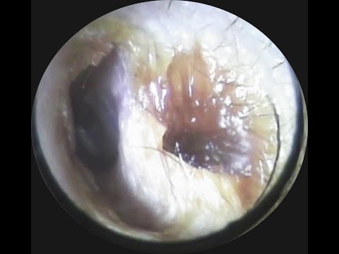 Vol.314【耳掃除】YouTube見てたら自分の耳が気になって・・熟成された耳垢♥eariss