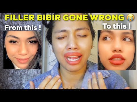 Aku buat filler / injection kat bibir dan aku menyesal 😭