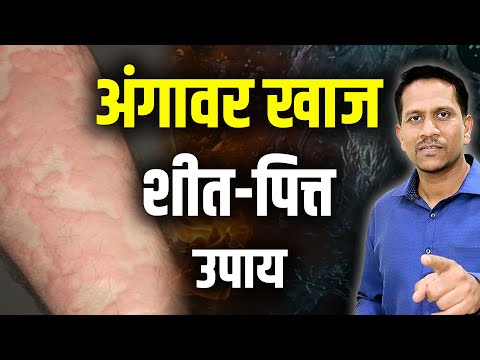 अंगावर खाज शीत पित्त | अंगावर खाज येण्याची कारणे आणि उपाय |Dr Nagarekar ||