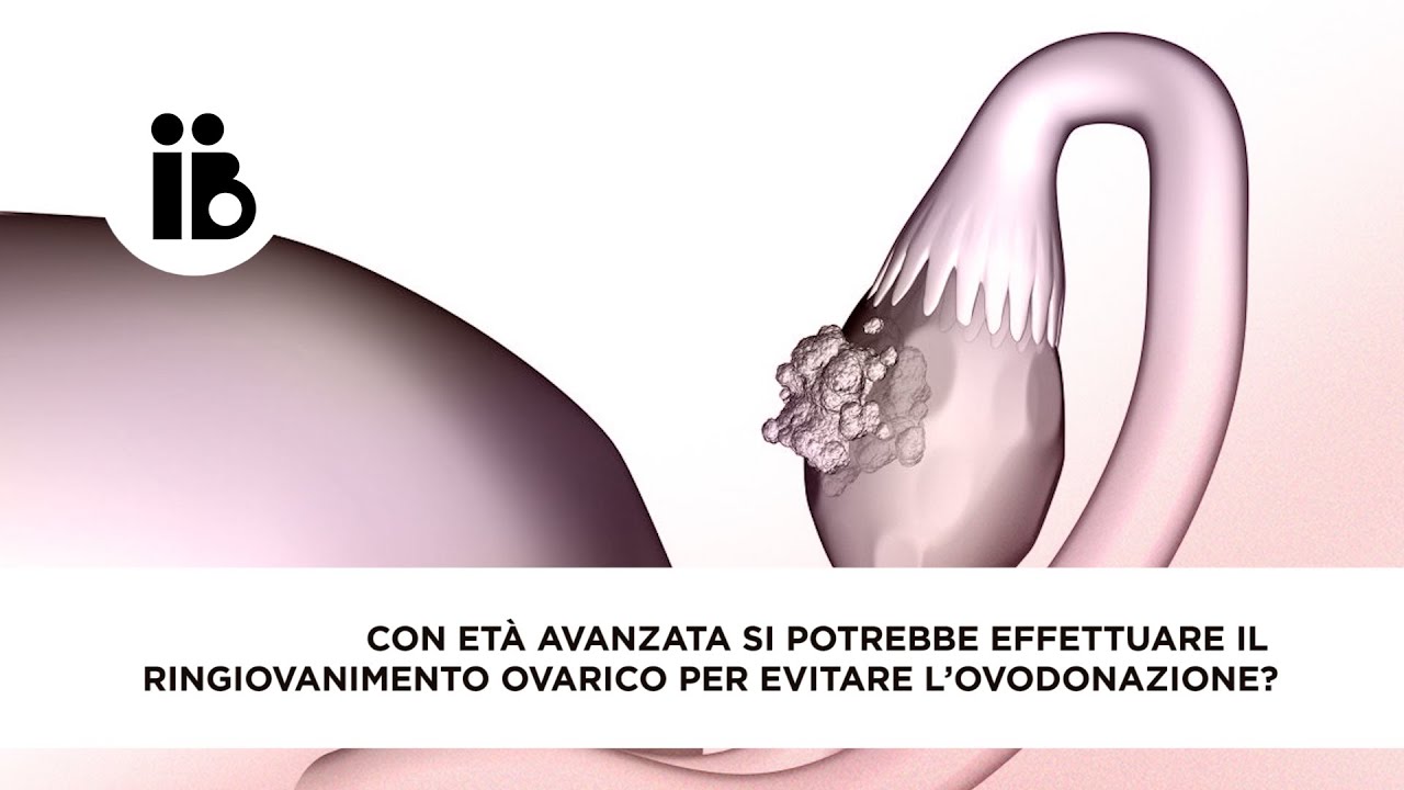 Con età avanzata si potrebbe effettuare il ringiovanimento ovarico per evitare l’ovodonazione?
