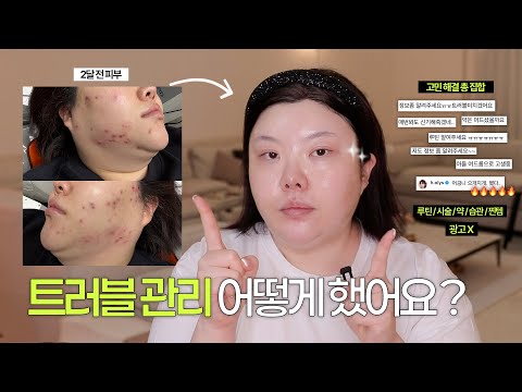*(sub) 성인 여드름 10년차가 2달만에 ‘ㅍㅈㅅ’ 잡고 피부 되찾은 썰+루틴
