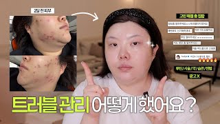 *(sub) 성인 여드름 10년차가 2달만에 ‘ㅍㅈㅅ’ 잡고 피부 되찾은 썰+루틴