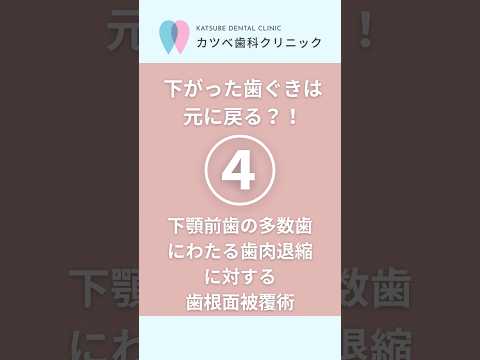 【歯ぐき再生シリーズ④】下顎前歯の多数歯にわたる歯肉退縮【術後11年後の経過公開】