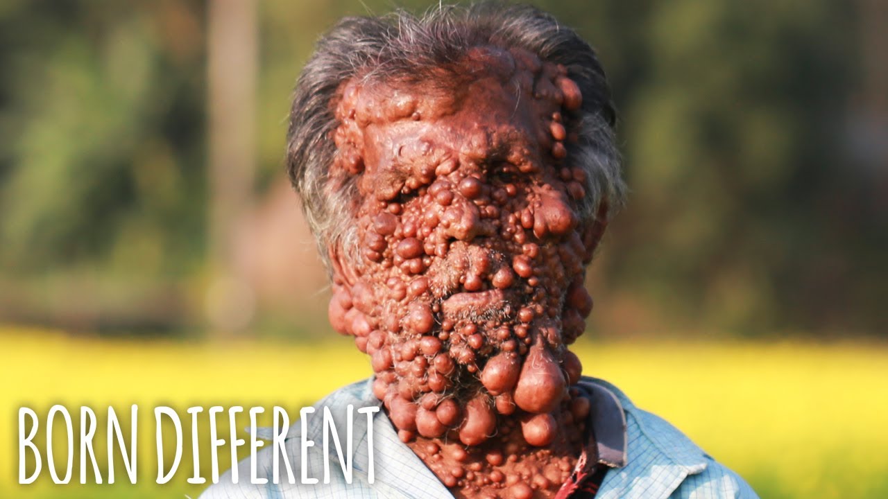 My life changing surgery helped me see again - born different