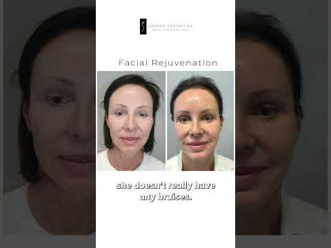 Dr. Grover Explains the SurgYlift