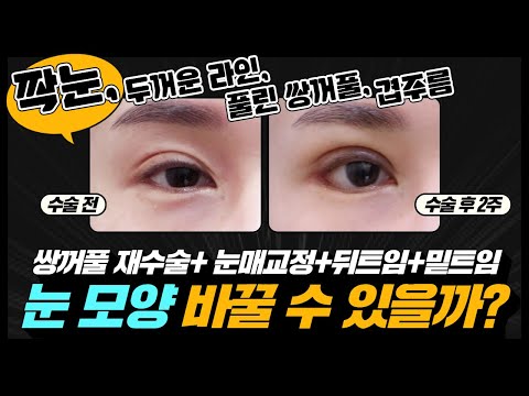 #풀린쌍꺼풀 #겹주름 고민🔥눈 모양 바뀔 수 있을까? (눈성형 2주차👀)#쌍꺼풀재수술 #눈매교정 #뒤밑트임