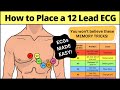 Electrode Placement and ECG Mnemonics