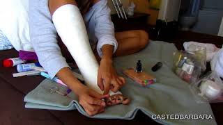 Foot care in a short leg cast (SLC)  | CASTEDBARABRA