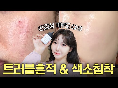 cc) 홈케어끝판왕! 트러블흔적&색소침착 쉽게 없애는 진짜 방법..🧡ㅣ아랑