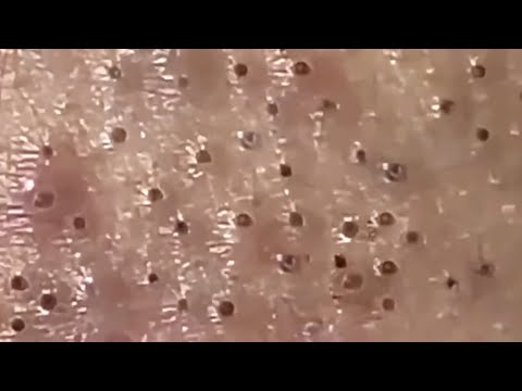 Blackheads & Whiteheads Satisfying Removal @0342