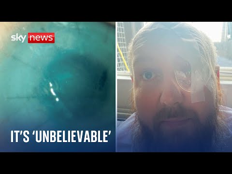 Battery acid attack victim reveals how donated placenta treatment saved his eye