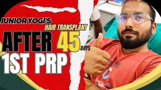 JUNIOR YOGI'S HAIR TRANSPLANT [ 1ST PRP ] at @ladensitaelucknow #hairtransplant #junioryogi