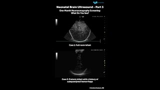 🧠🍼 One-Month Neurosonography Screening: What Do You See?