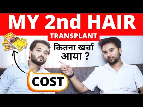 My Second Hair Transplant After 3 Years? My Hair Transplant Cost In 2025