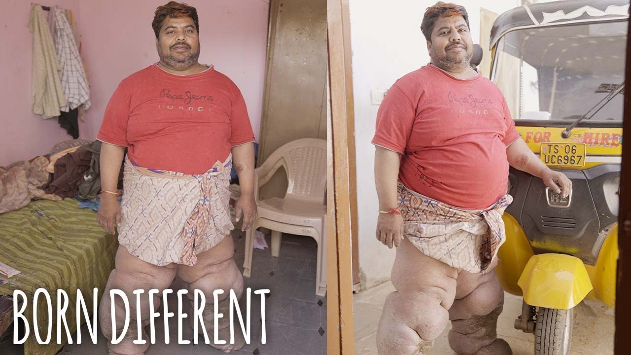 The man with elephant sized legs - born different