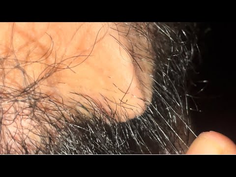 ASMR HAIR INGROWN HAIR BEARD RELAXING ASME VEDIO  204
